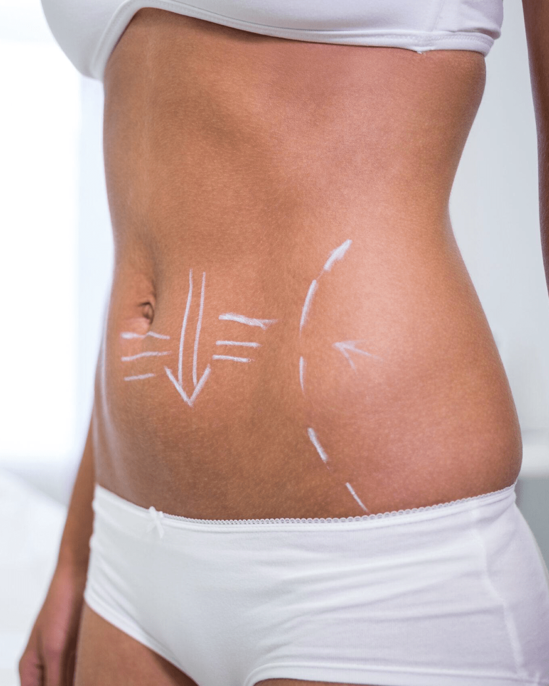 CRIOLIPOLISIS