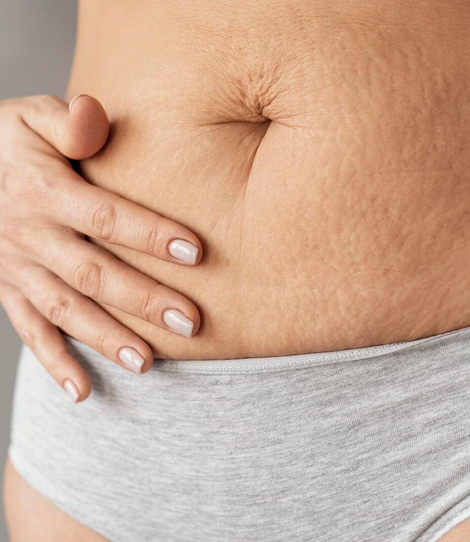 vela slim plus celulitis