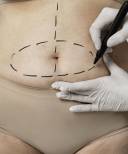 ABDOMINOPLASTIA